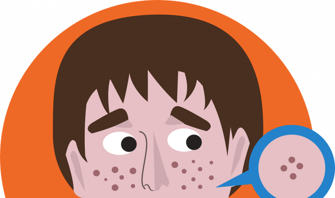How to treat acne with Natural product